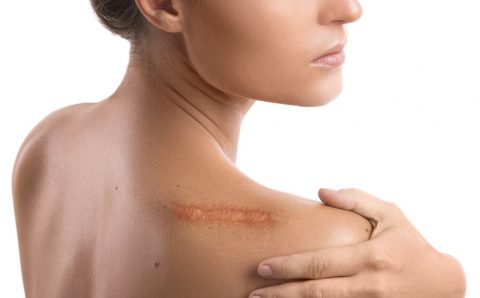Comment l&rsquo;ostéopathie soigne vos cicatrices ?